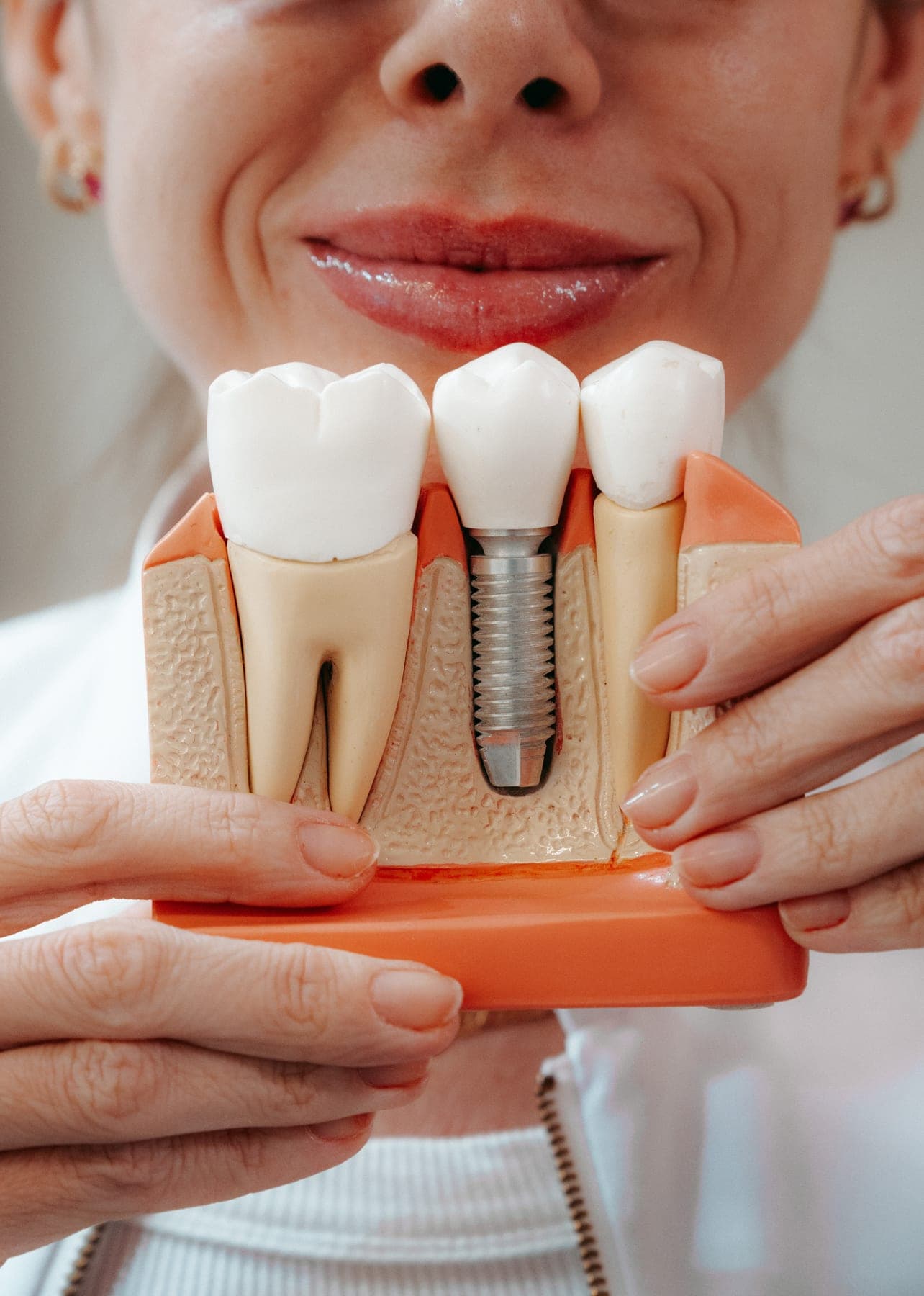 Implantes na OralClin, em Itapoá